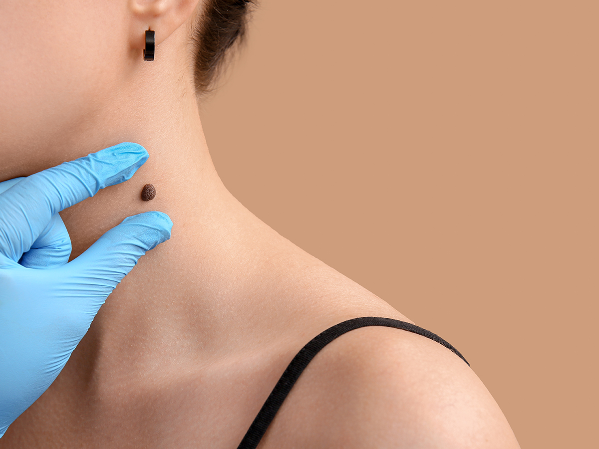 Ādas veidojuma (dzimumzīmes) profesionāla novērtēšana kakla zonā dermatologa kabinetā.